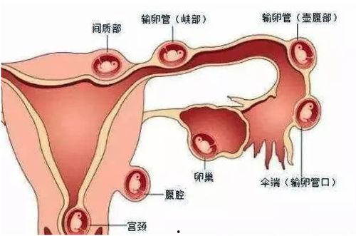 妇产科吃瓜宫外孕,妇产科里的“吃瓜”故事