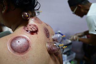 拔火罐吃瓜,夏日养生新风尚